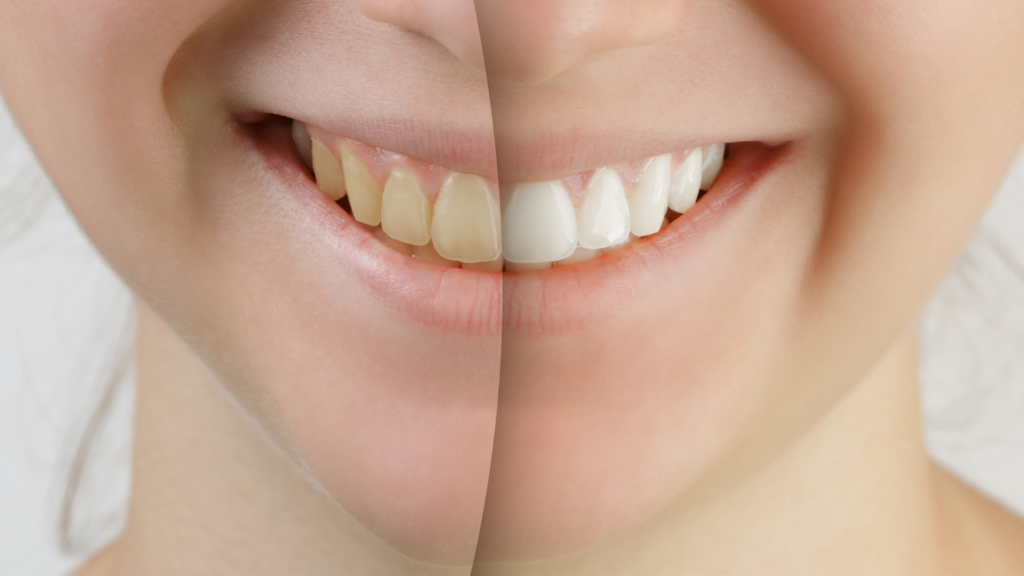 Na dentální hygieně se dozvíte více k bělení zubů.