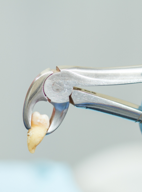 Vytržení zubu, extrakce zubu, jak se chovat po vytržení zubu