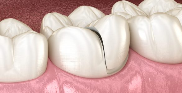 Onlay,Ceramic,Crown,Fixation,Over,Tooth.,Medically,Accurate,3d,Illustration